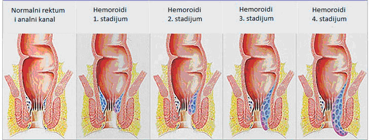 hemoroi